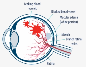 Eye With Macular Edema Following Retinal Vein Occlusion - Edema Macular Png, Transparent Png, Transparent PNG