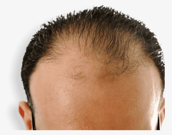 Receding Hairline - Will Castor Oil Regrow Hair, HD Png Download, Transparent PNG