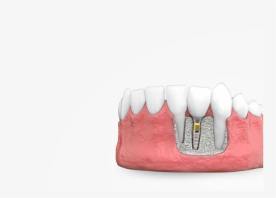 Dental Implants - Marking Tools, HD Png Download, Transparent PNG