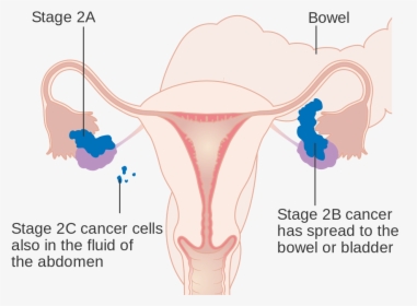 Stage 1 Ovarian Cancer Staging, HD Png Download, Transparent PNG