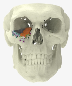 Xilloc Medical B - 3d Printed Titanium Plate For Zygomatic Fracture, HD Png Download, Transparent PNG