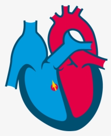 Perimembranous Vsd - Congenital Heart Disease Clipart, HD Png Download, Transparent PNG