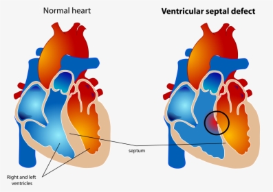Small Ventricular Septal Defect, HD Png Download, Transparent PNG