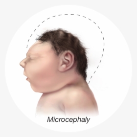 Baby Small Head - Zika Baby, HD Png Download, Transparent PNG