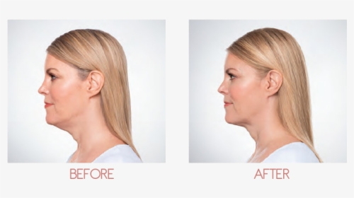 Chin Fat Removal, HD Png Download, Transparent PNG