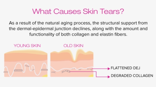 Amige 161110 What Causes Skin Tears - Dermal Epidermal Junction Aging, HD Png Download, Transparent PNG