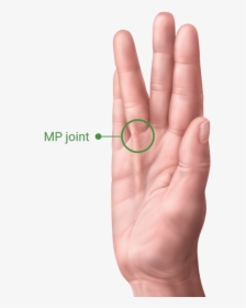 A Hand With Dupuytren’s Contracture Showing The Pip - Facts On Hand Dupuytren's Contracture, HD Png Download, Transparent PNG