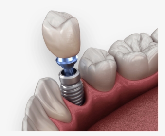 Dental Implants - Implant Dental Png, Transparent Png, Transparent PNG