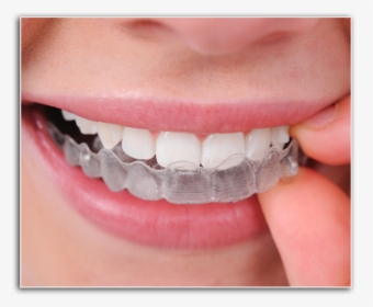 Closeup Of Patient Placing Invisalign Tray - Invisalign Braces Cost In India, HD Png Download, Transparent PNG