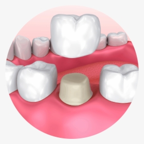 What Is A Dental Crown - Dental Crown, HD Png Download, Transparent PNG