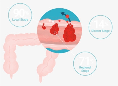 Colorectal Cancer Survival Rates - Illustration, HD Png Download, Transparent PNG