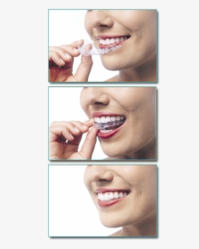 Invisalign - Someone With Clear Aligners, HD Png Download, Transparent PNG