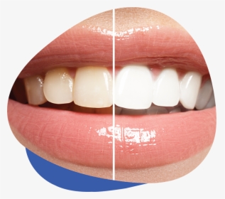 Teeth Whitening - Ranking Past Do Zębów Wybielających, HD Png Download, Transparent PNG