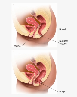 Illustration Showing A Normal Vagina And One With A - Posterior Prolapse, HD Png Download, Transparent PNG