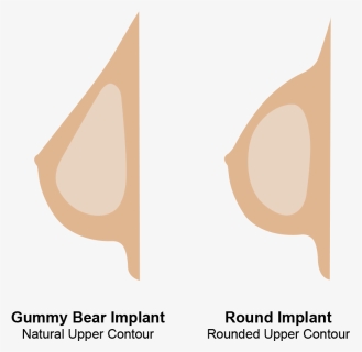Round And Gummy Bear Implants, HD Png Download, Transparent PNG