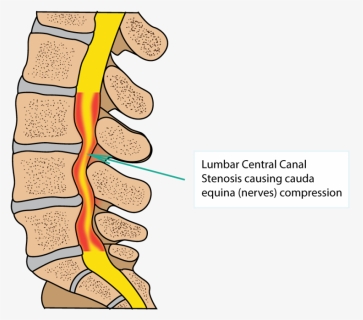 Spinal Stenosis, HD Png Download, Transparent PNG