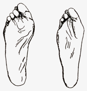 Fig46 Deformities Of Feet Resulting From Bad Shoes, HD Png Download ...