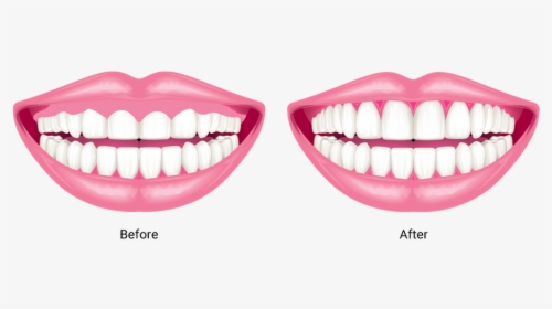 Gum Drawing Front Tooth - Gums, HD Png Download, Transparent PNG
