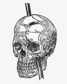 Recovery From The Passage Of An Iron Bar Through The - Phineas Gage Skull, HD Png Download, Transparent PNG
