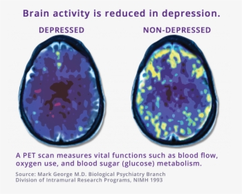 Pet Scan Comparing Depressed Brain To Non-depressed - Tms Depression, HD Png Download, Transparent PNG