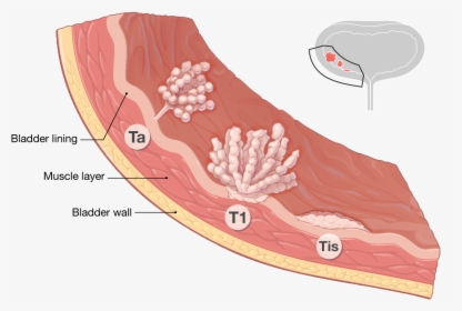 Bladder Cancer Staging, HD Png Download, Transparent PNG