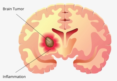 Brain Tumor Label - Brain Tumor Clipart, HD Png Download, Transparent PNG