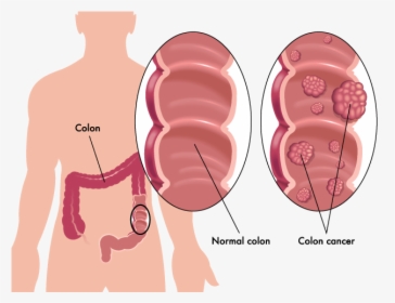 Colon Cancer Tumors - Colon Cancer Vs Healthy Colon, HD Png Download, Transparent PNG