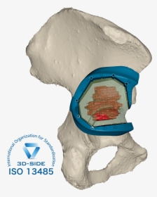 Bone Tumor Resection - Illustration, HD Png Download, Transparent PNG