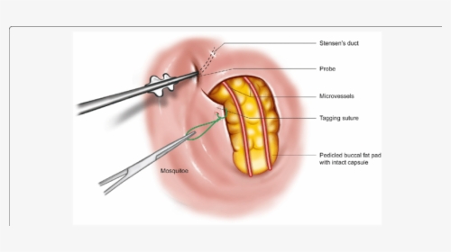Surgical Procedure For The - Herniation Of Buccal Fat Pad, HD Png Download, Transparent PNG