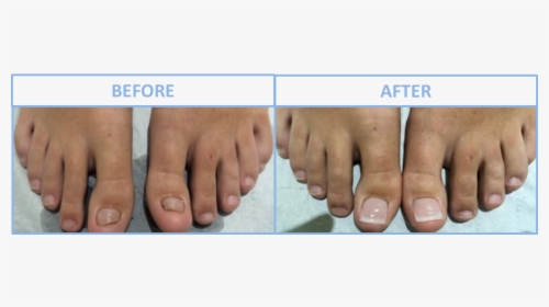 Transparent Fingernail Png - Toe Nail Reconstruction Surgery, Png Download, Transparent PNG
