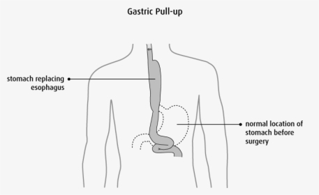Esophageal Cancer Gastric Pull Up, HD Png Download, Transparent PNG