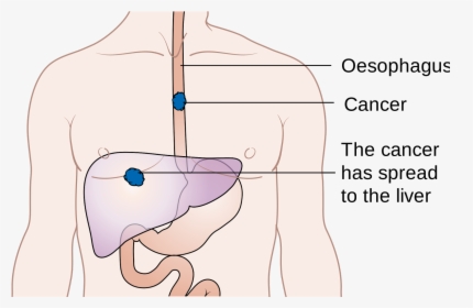 Am Worried About Esophagus Cancer, HD Png Download, Transparent PNG